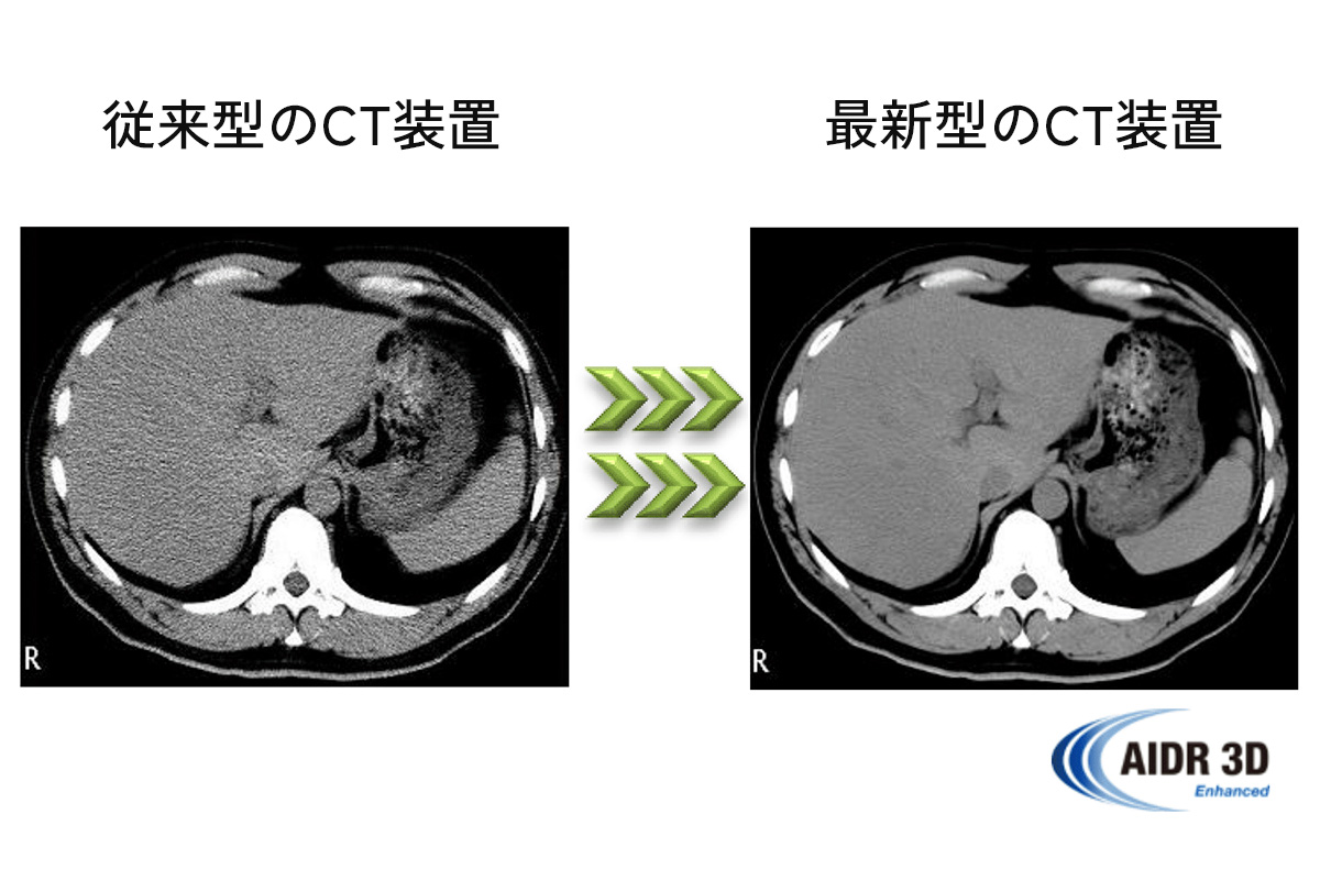 CT検査　最新の被ばく抑制機能を搭載